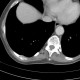 Adrenal metastasis and skeletal metastasis of pulmonary carcinoma, correlation, initial examination: CT - Computed tomography